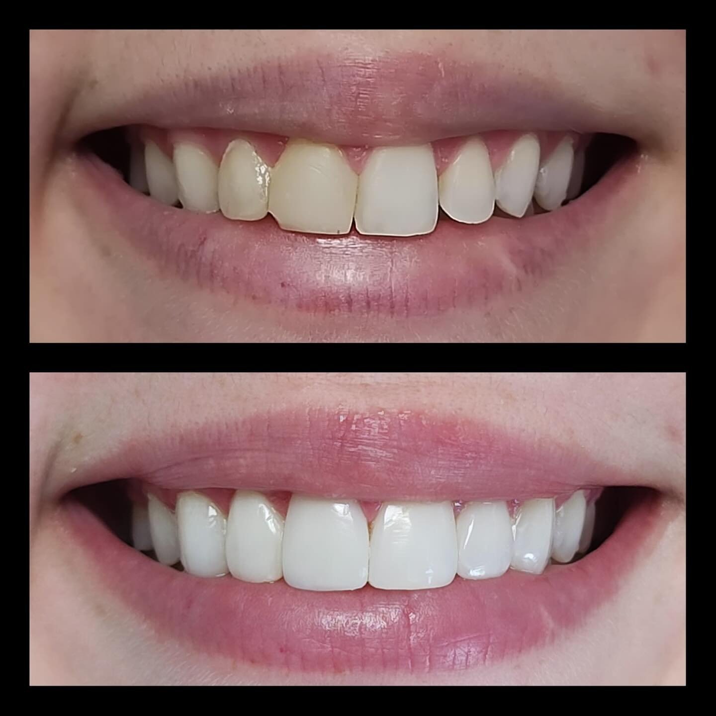 Clareamento dental