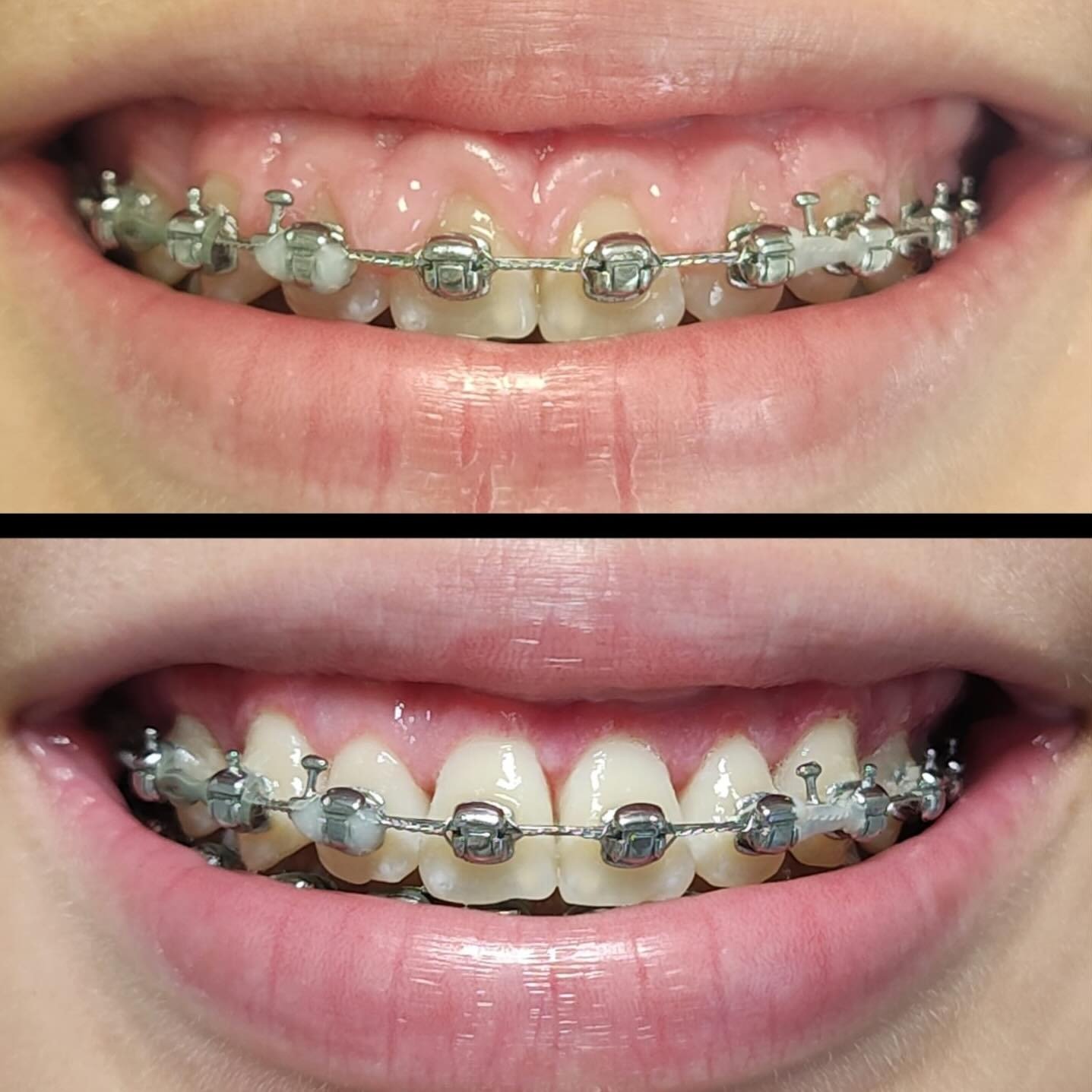 Facetas e estética